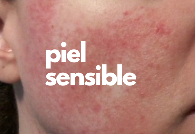 piel sensible